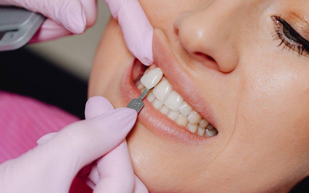 5 Reasons Custom Veneers Outshine Traditional Ones